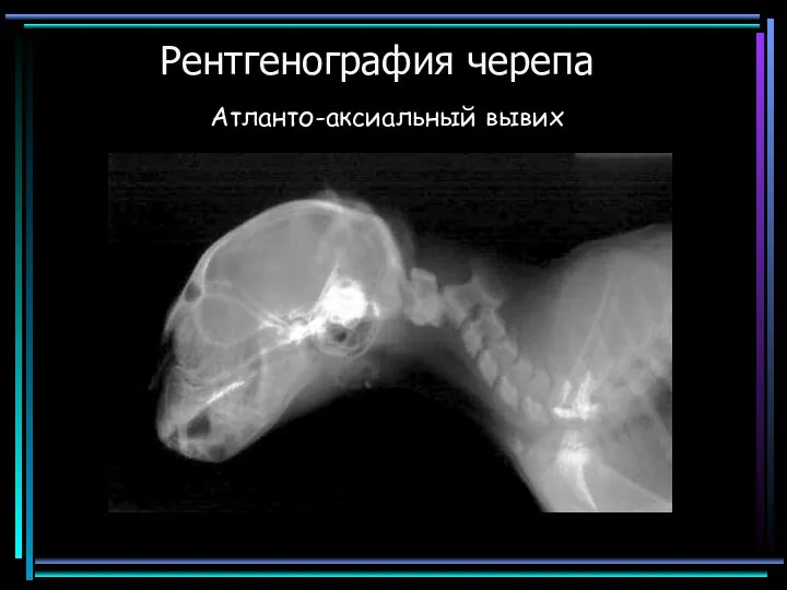 Рентгенография черепа Атланто-аксиальный вывих