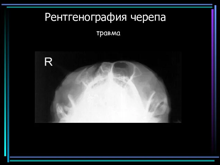 Рентгенография черепа травма
