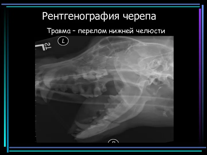 Рентгенография черепа Травма – перелом нижней челюсти