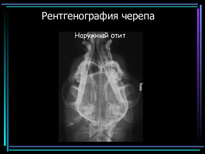 Рентгенография черепа Наружный отит