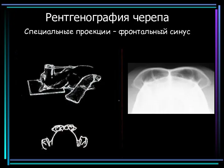 Рентгенография черепа Специальные проекции – фронтальный синус