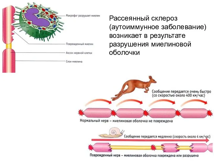 Рассеянный склероз (аутоиммунное заболевание) возникает в результате разрушения миелиновой оболочки