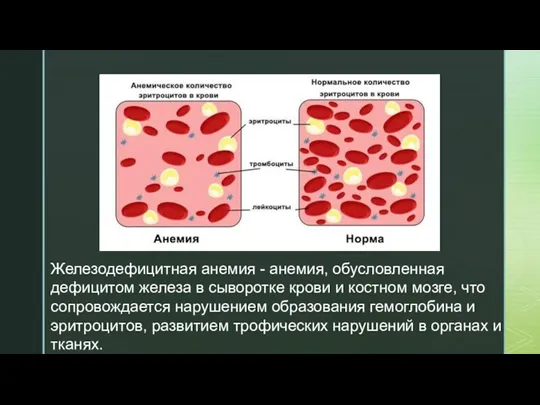 Железодефицитная анемия - анемия, обусловленная дефицитом железа в сыворотке крови и костном