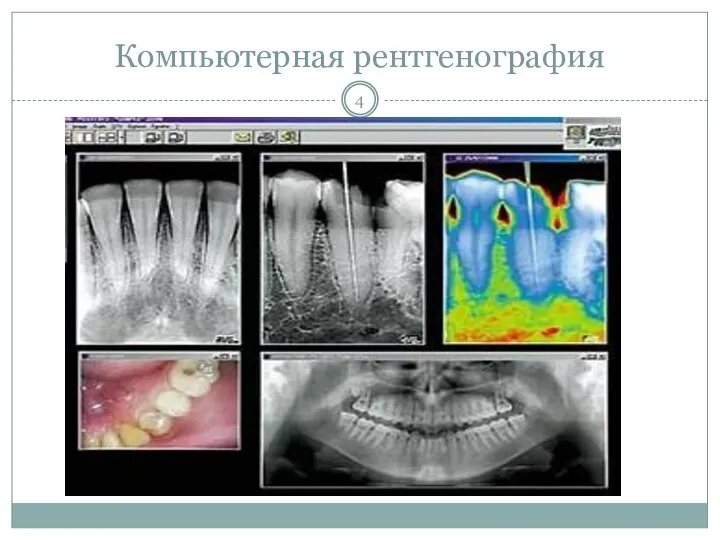 Компьютерная рентгенография