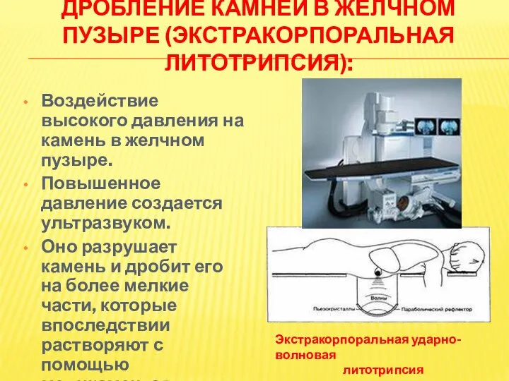 ДРОБЛЕНИЕ КАМНЕЙ В ЖЕЛЧНОМ ПУЗЫРЕ (ЭКСТРАКОРПОРАЛЬНАЯ ЛИТОТРИПСИЯ): Воздействие высокого давления на камень