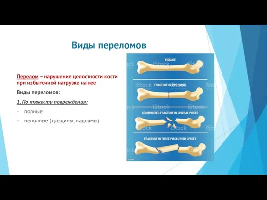 Виды переломов Перелом – нарушение целостности кости при избыточной нагрузке на нее