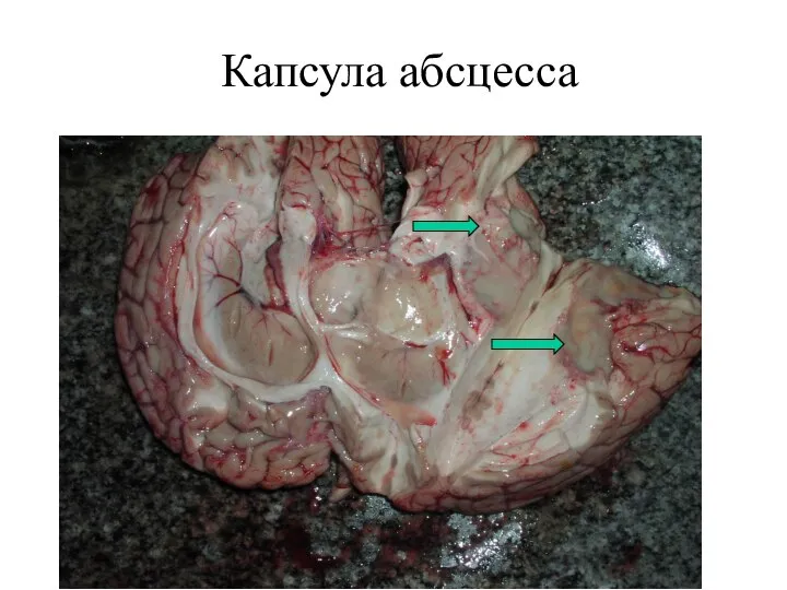 Капсула абсцесса