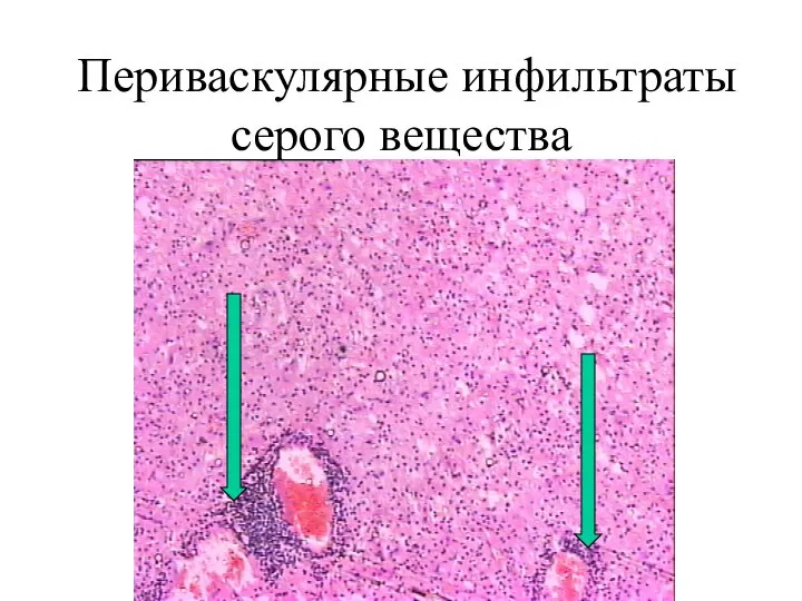 Периваскулярные инфильтраты серого вещества