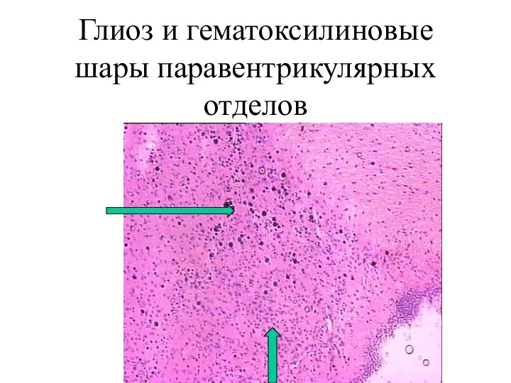 Глиоз и гематоксилиновые шары паравентрикулярных отделов