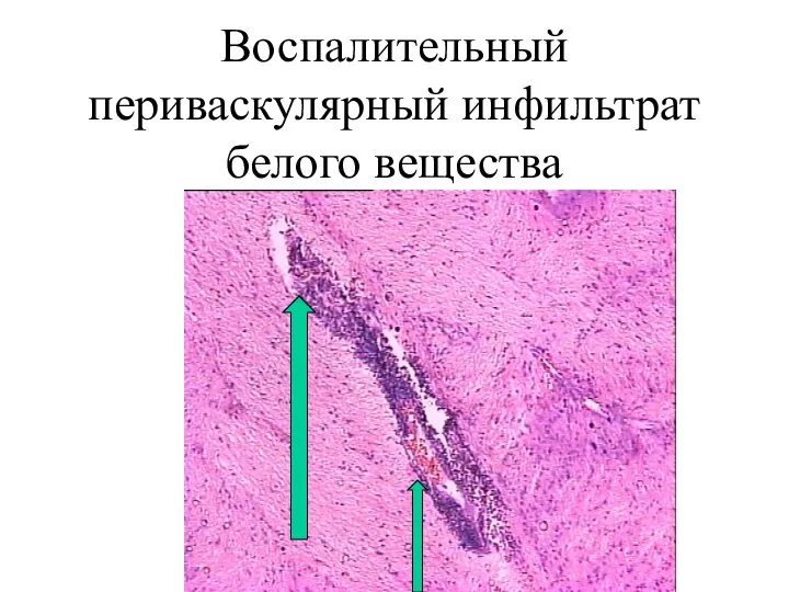 Воспалительный периваскулярный инфильтрат белого вещества