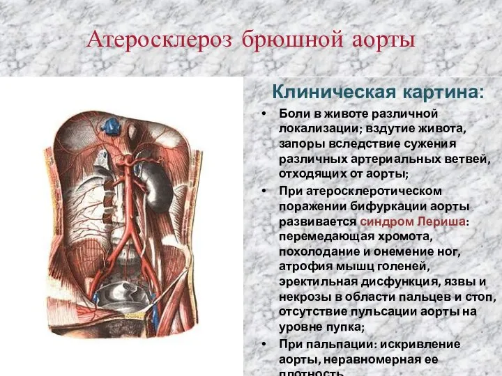 Атеросклероз брюшной аорты Клиническая картина: Боли в животе различной локализации; вздутие живота,