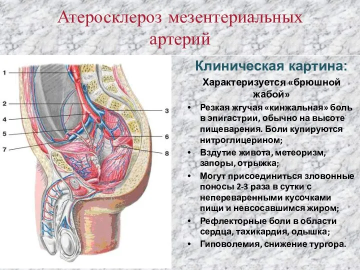 Атеросклероз мезентериальных артерий Клиническая картина: Характеризуется «брюшной жабой» Резкая жгучая «кинжальная» боль