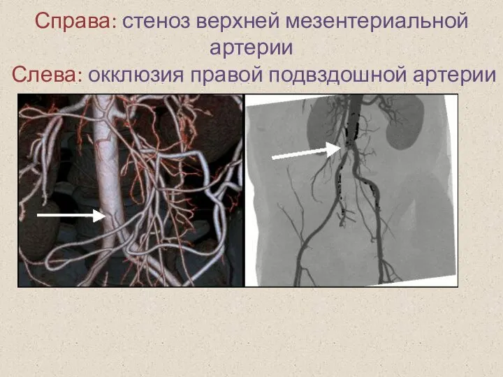 Справа: стеноз верхней мезентериальной артерии Слева: окклюзия правой подвздошной артерии