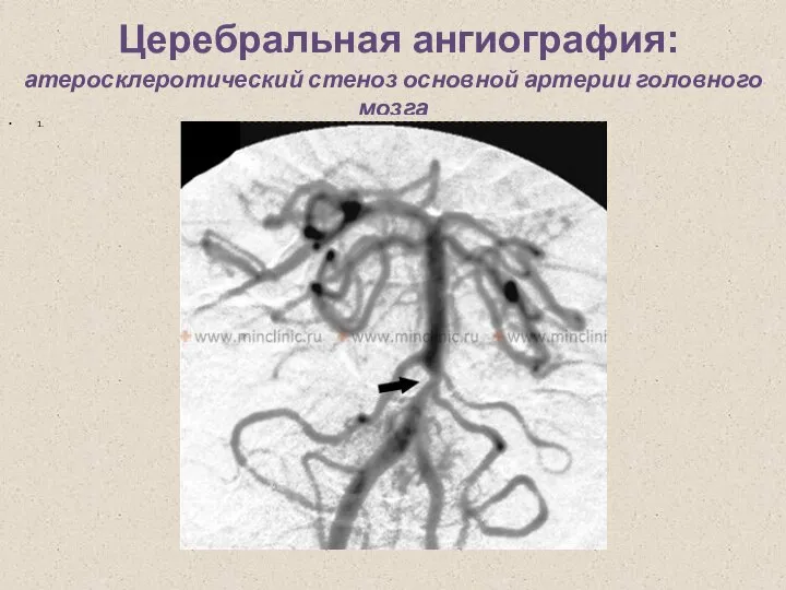 Церебральная ангиография: атеросклеротический стеноз основной артерии головного мозга 1.