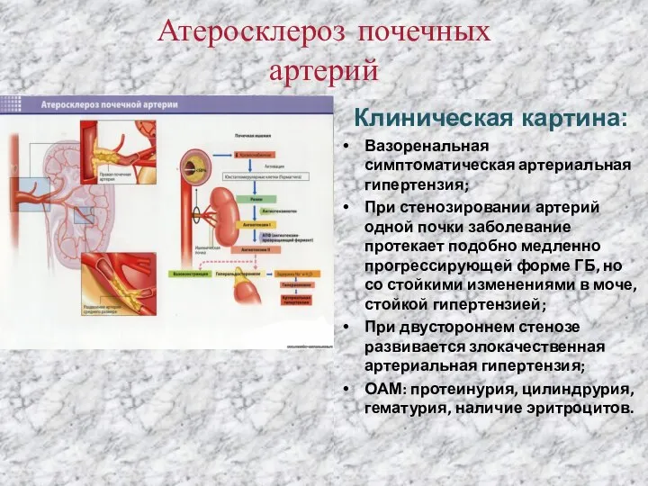 Атеросклероз почечных артерий Клиническая картина: Вазоренальная симптоматическая артериальная гипертензия; При стенозировании артерий