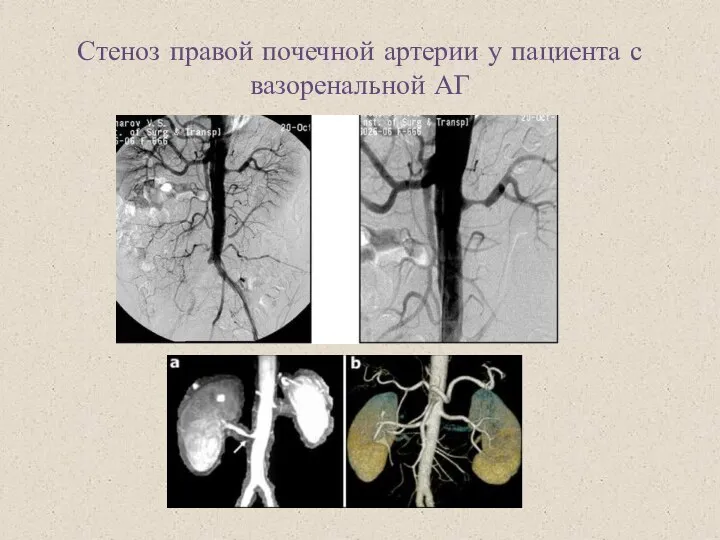 Стеноз правой почечной артерии у пациента с вазоренальной АГ .