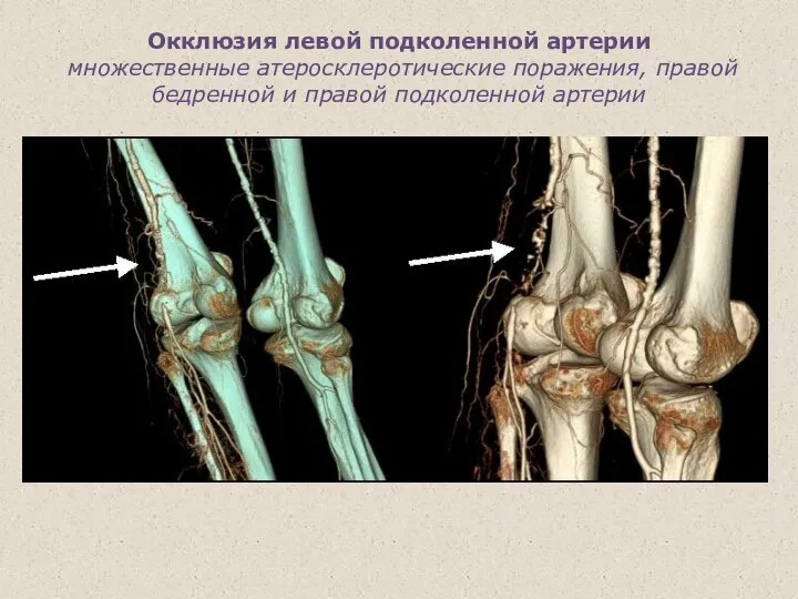 Окклюзия левой подколенной артерии множественные атеросклеротические поражения, правой бедренной и правой подколенной артерии .