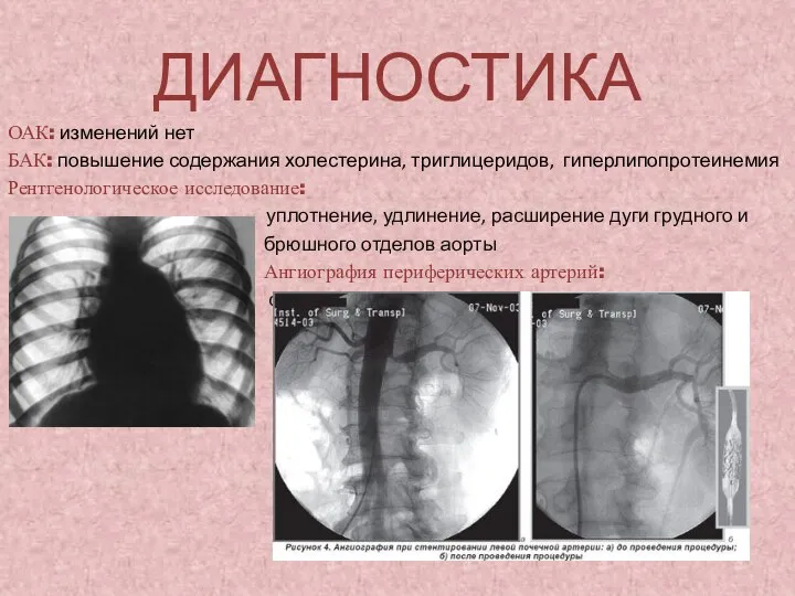 ДИАГНОСТИКА ОАК: изменений нет БАК: повышение содержания холестерина, триглицеридов, гиперлипопротеинемия Рентгенологическое исследование: