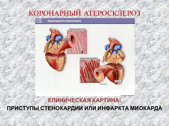 КОРОНАРНЫЙ АТЕРОСКЛЕРОЗ КЛИНИЧЕСКАЯ КАРТИНА: ПРИСТУПЫ СТЕНОКАРДИИ ИЛИ ИНФАРКТА МИОКАРДА