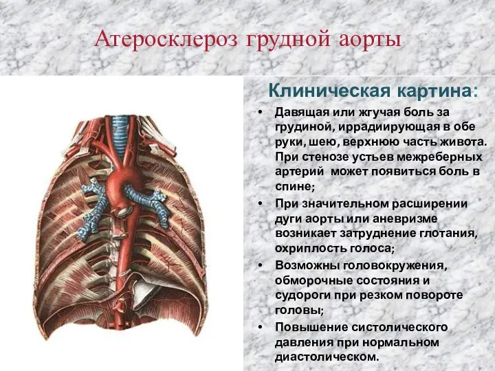 Атеросклероз грудной аорты Клиническая картина: Давящая или жгучая боль за грудиной, иррадиирующая