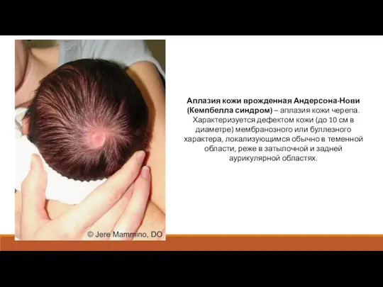 Аплазия кожи врожденная Андерсона-Нови (Кемпбелла синдром) – аплазия кожи черепа. Характеризуется дефектом