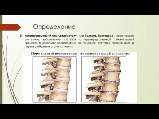 Определение Анкилозирующий спондилоартрит, или болезнь Бехтерева - хроническое системное заболевание суставов с