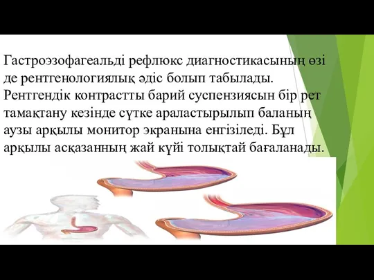 Гастроэзофагеальді рефлюкс диагностикасының өзі де рентгенологиялық әдіс болып табылады. Рентгендік контрастты барий