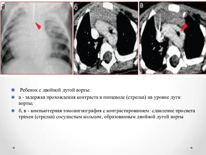 Ребенок с двойной дугой аорты: а - задержка прохождения контраста в пищеводе