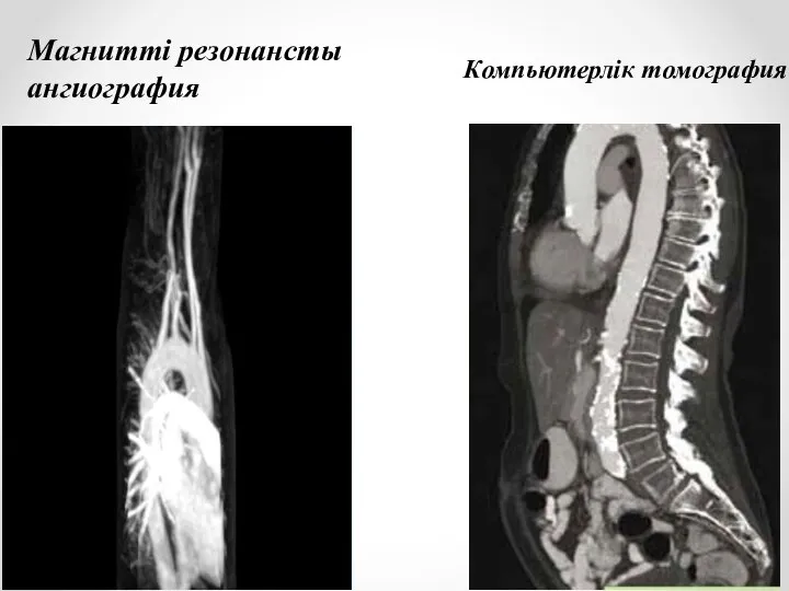 Магнитті резонансты ангиография Компьютерлік томография
