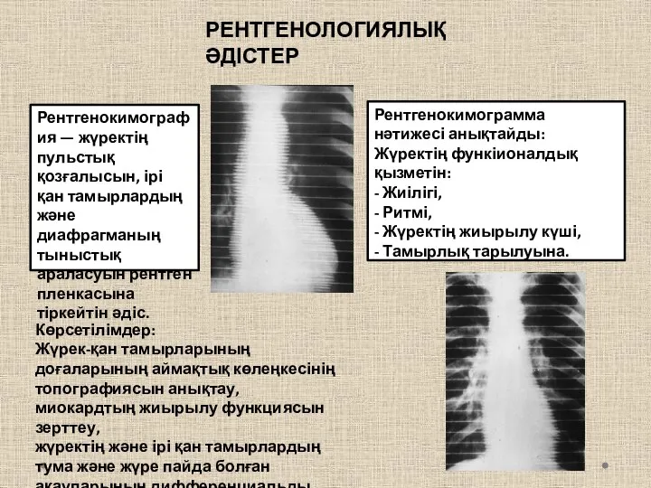 РЕНТГЕНОЛОГИЯЛЫҚ ӘДІСТЕР Рентгенокимография — жүректің пульстық қозғалысын, ірі қан тамырлардың және диафрагманың