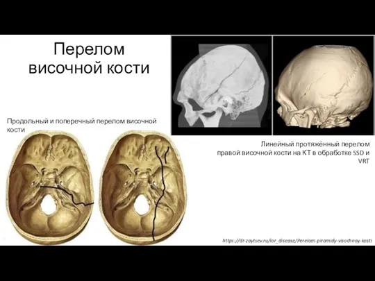 Перелом височной кости Линейный протяжённый перелом правой височной кости на КТ в