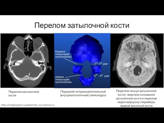 Перелом затылочной кости Перелом затылочной кости Передний интраокципитальный (внутризатылочный) синхондроз Перелом чешуи