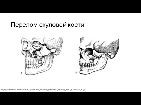 Перелом скуловой кости https://www.medskop.ru/chelust/operativnoe_lechenie_perelomov_skulovoy_kosti_i_skulovoy_dugi/