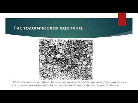 Гистологическая картина: Хронический пиелонефрит. Коллоидные цилиндры в расширенных канальцах почек и воспалительная