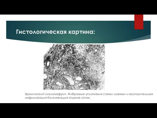 Гистологическая картина: Хронический пиелонефрит. Фиброзные уплотнения стенки лоханки и воспалительная инфильтрация близлежащих отделов почек.