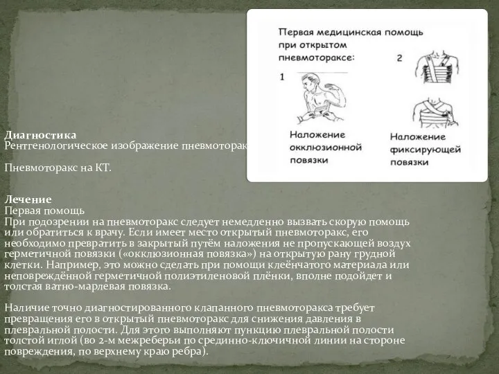 Диагностика Рентгенологическое изображение пневмоторакса. Пневмоторакс на КТ. Лечение Первая помощь При подозрении