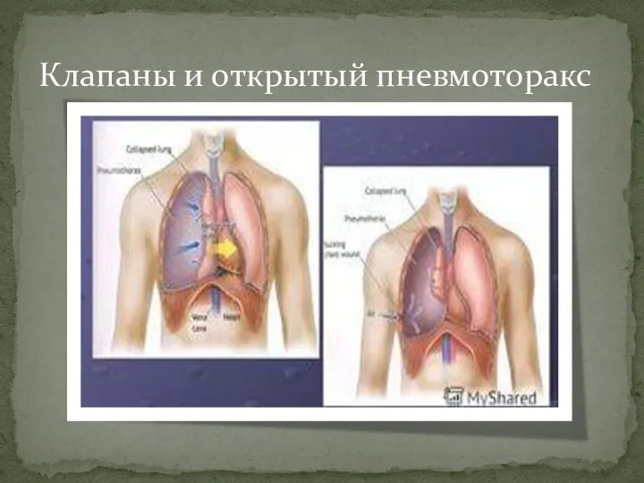 Клапаны и открытый пневмоторакс