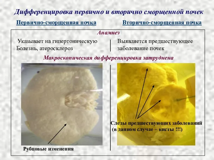 Указывает на гипертоническую Болезнь, атеросклероз Дифференцировка первично и вторично сморщенной почек Первично-сморщенная