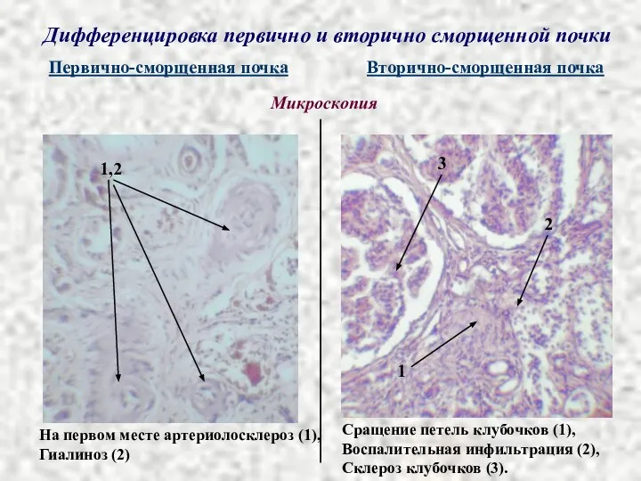 Дифференцировка первично и вторично сморщенной почки Первично-сморщенная почка Вторично-сморщенная почка Микроскопия На