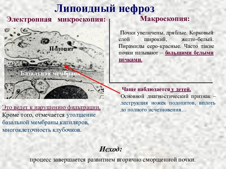 Липоидный нефроз Исход: процесс завершается развитием вторично сморщенной почки. Электронная микроскопия: Макроскопия: