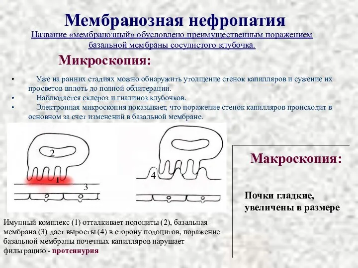 Мембранозная нефропатия Микроскопия: Макроскопия: Почки гладкие, увеличены в размере Название «мембранозный» обусловлено