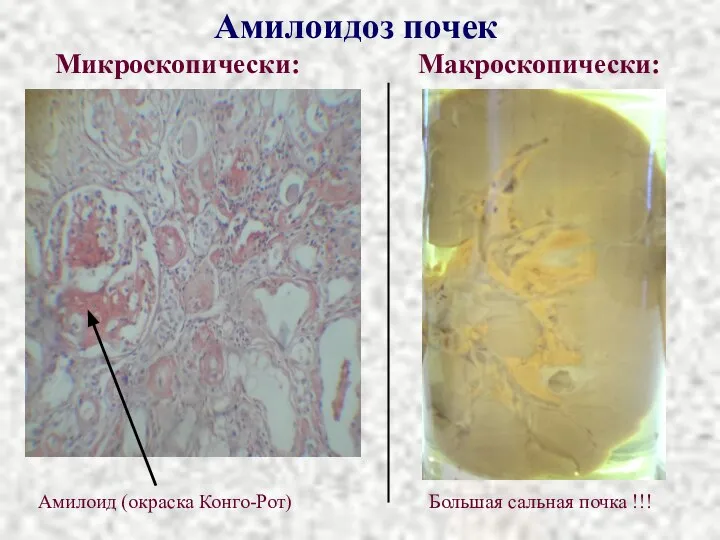 Амилоидоз почек Микроскопически: Макроскопически: Большая сальная почка !!! Амилоид (окраска Конго-Рот)