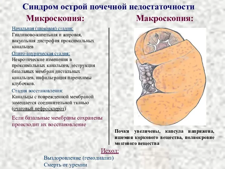 Микроскопия: Макроскопия: Синдром острой почечной недостаточности Начальная (шоковая) стадия: Гиалиново-капельная и жировая,