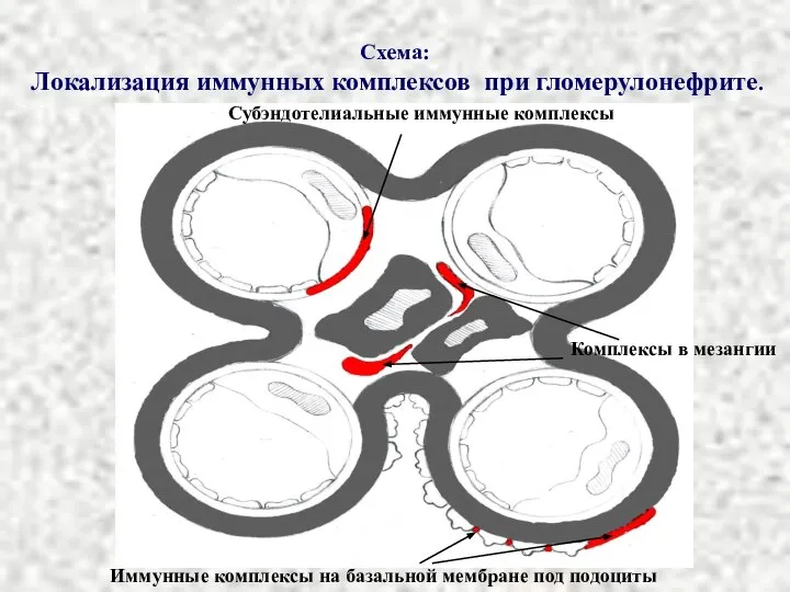Схема: Локализация иммунных комплексов при гломерулонефрите. Субэндотелиальные иммунные комплексы Комплексы в мезангии