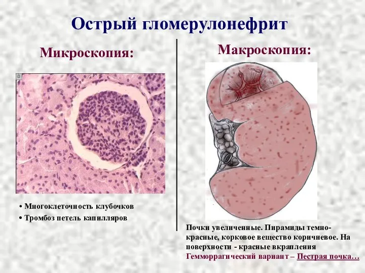 Острый гломерулонефрит Микроскопия: Макроскопия: Многоклеточность клубочков Тромбоз петель капилляров Почки увеличенные. Пирамиды