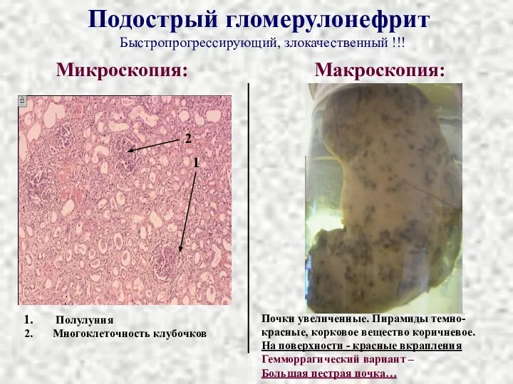 Подострый гломерулонефрит Микроскопия: Макроскопия: Полулуния Многоклеточность клубочков 2 1 Почки увеличенные. Пирамиды