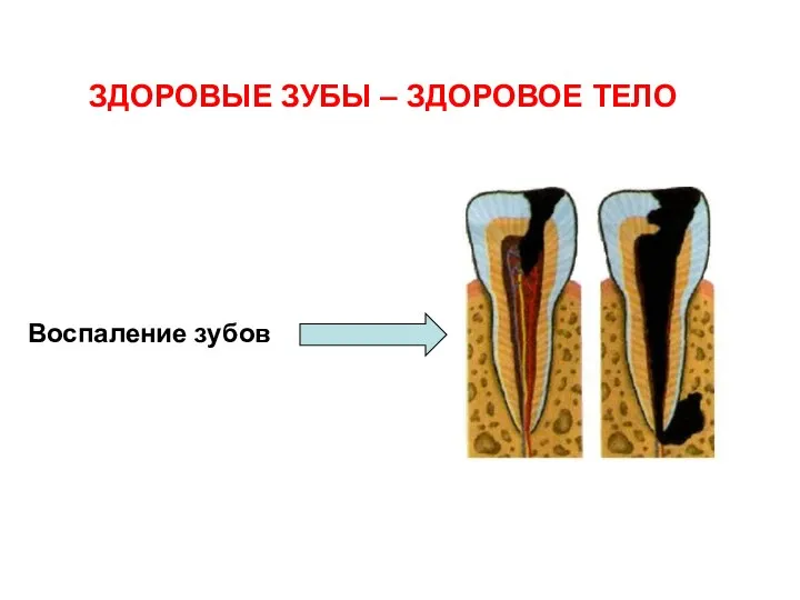 ЗДОРОВЫЕ ЗУБЫ – ЗДОРОВОЕ ТЕЛО Воспаление зубов