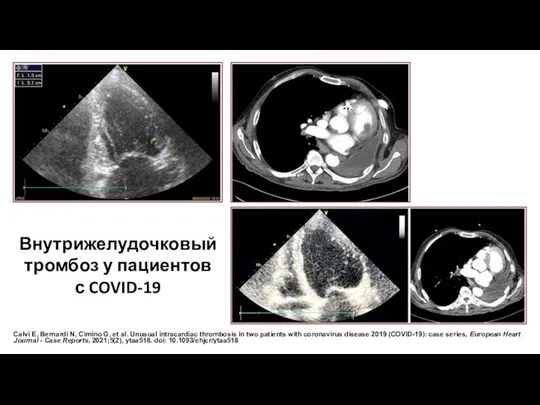 Calvi E, Bernardi N, Cimino G, et al. Unusual intracardiac thrombosis in