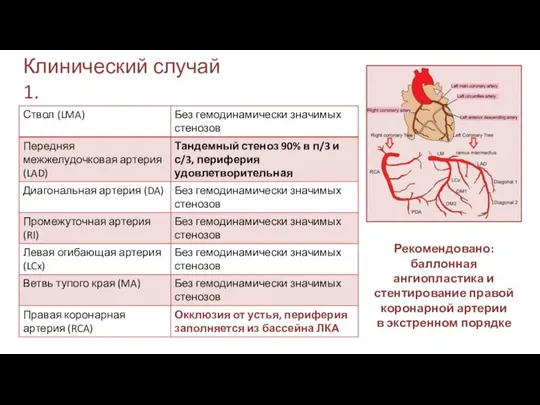 Клинический случай 1. Рекомендовано: баллонная ангиопластика и стентирование правой коронарной артерии в экстренном порядке