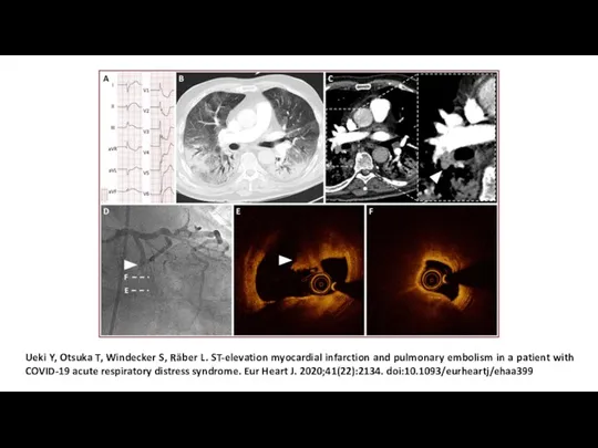 Ueki Y, Otsuka T, Windecker S, Räber L. ST-elevation myocardial infarction and